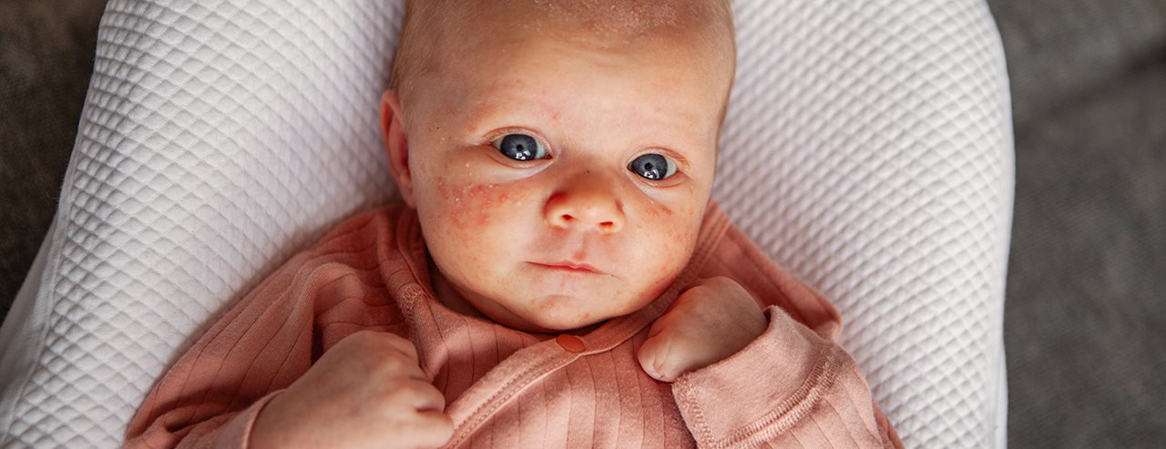 Akne pri dojenčkih: Kaj lahko storite