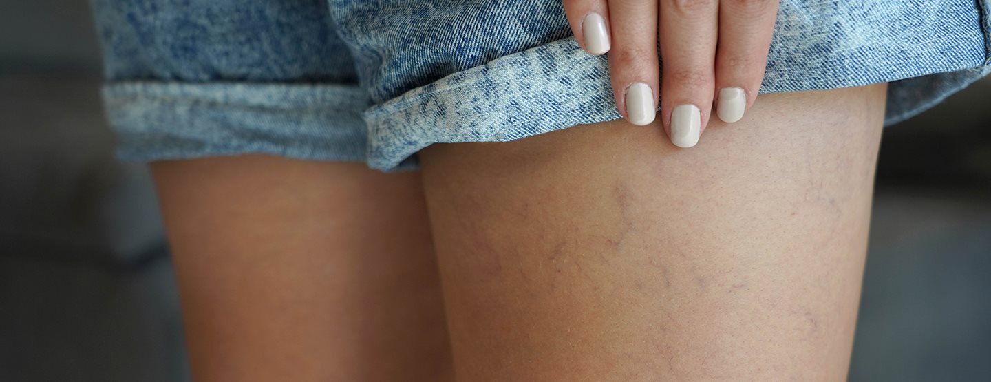 Kako odstraniti pajkaste vene? Za nasvet smo povprašali dermatologe!