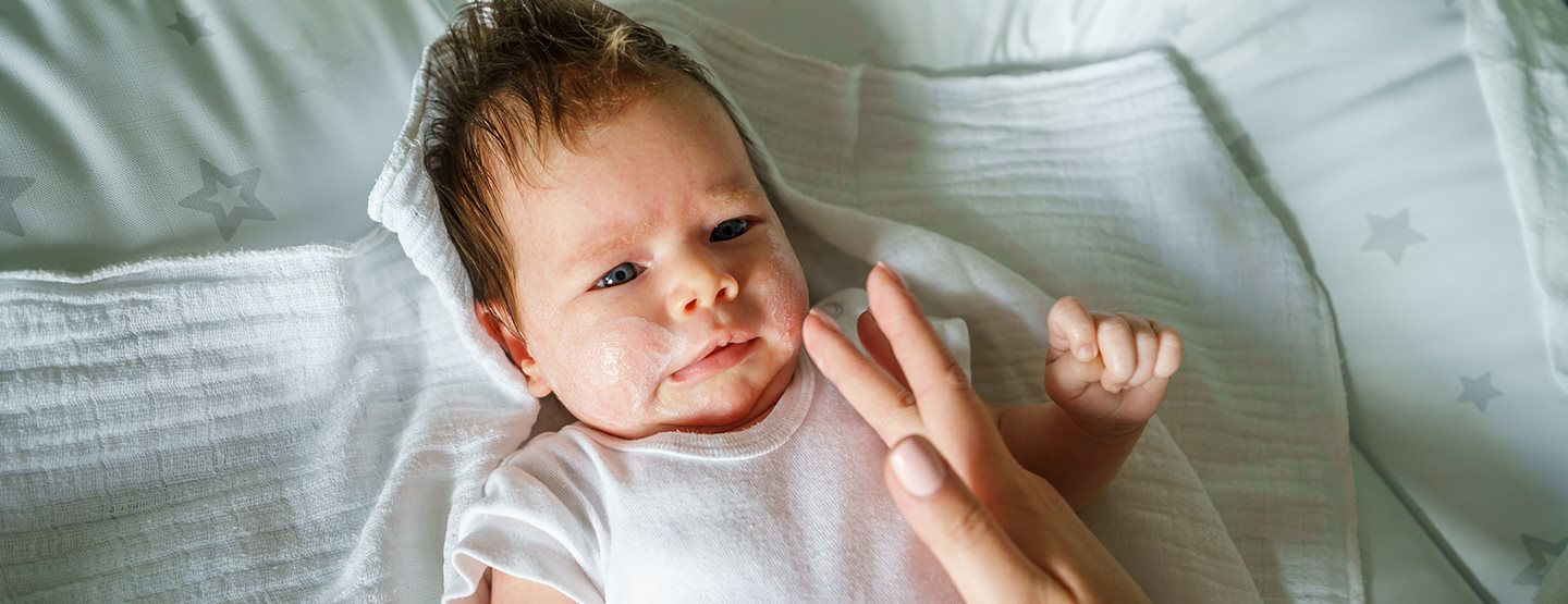 Atopijski dermatitis pri dojenčkih in otrocih: dermatologi pojasnjujejo, kaj morajo vedeti starši