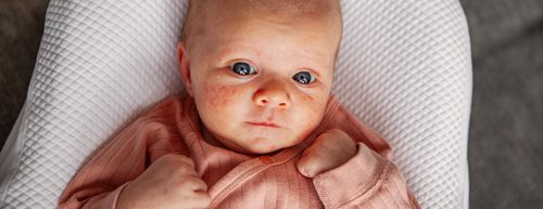 Akne pri dojenčkih: Kaj lahko storite